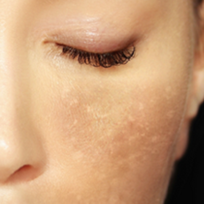 Close up on woman's closed eye and cheek with dark spots on it