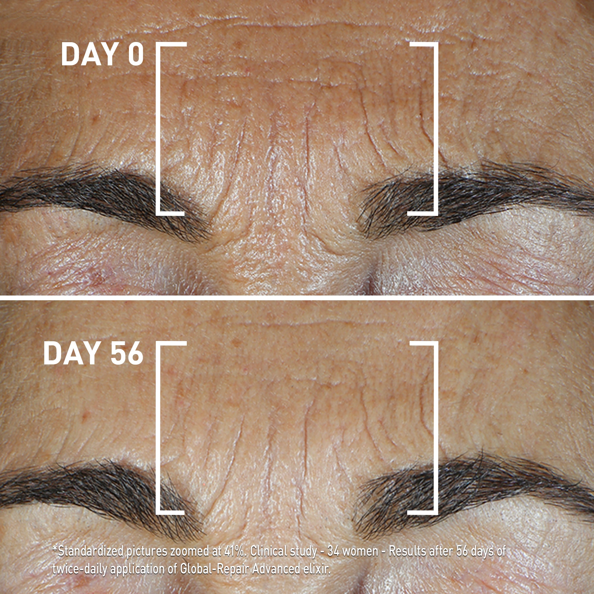 Day 0 and Day 56 showing reduced wrinkles after using FILORGA GLOBAL-REPAIR ADVANCED ELIXIR