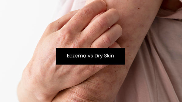 Eczema vs Dry Skin