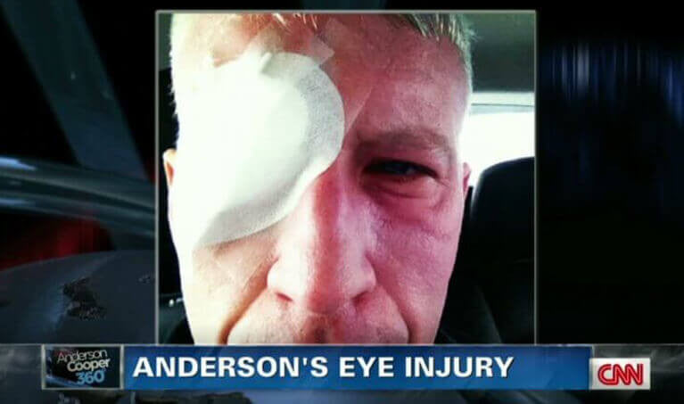Anderson Cooper Eye Injury