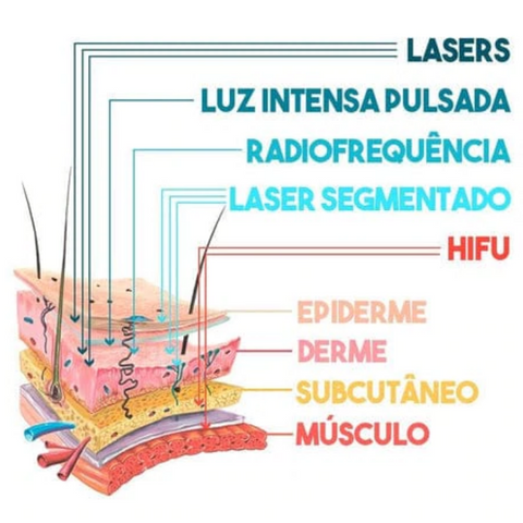 Como Funciona o Lifting Microfocado Mini Hifu Disponível em: www.descontara.com