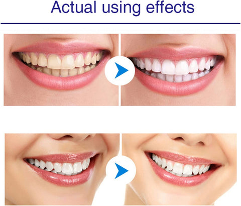 teeth whitening pen before and after