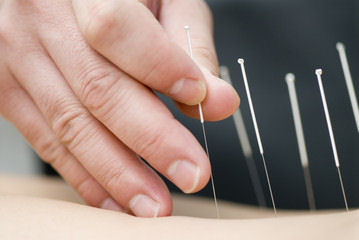 Acupuncture contre le stress