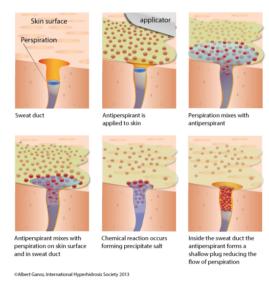 A diagram showing how antiperspirant blocks the sweat ducts.