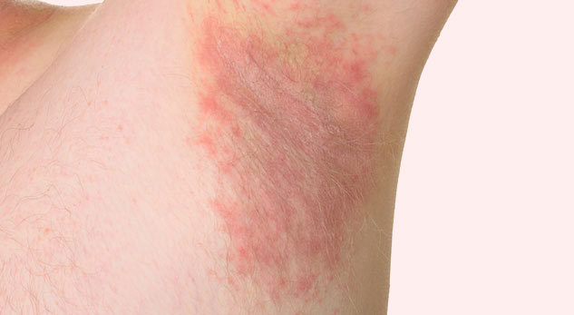 Itchy Armpits? Top Causes And Possible Solutions