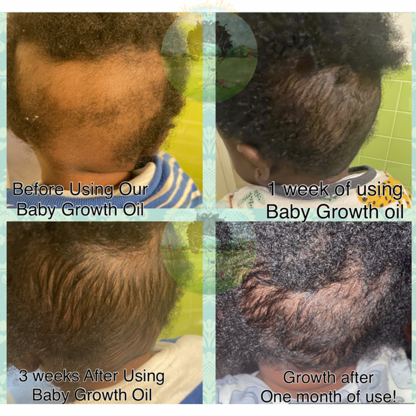 Babys hair falling out pics  September 2018 Babies  Forums  What to  Expect