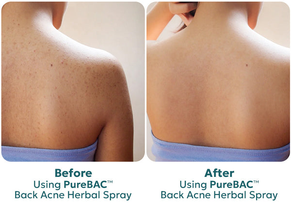 PureBAC™ Back Acne Herbal Spray