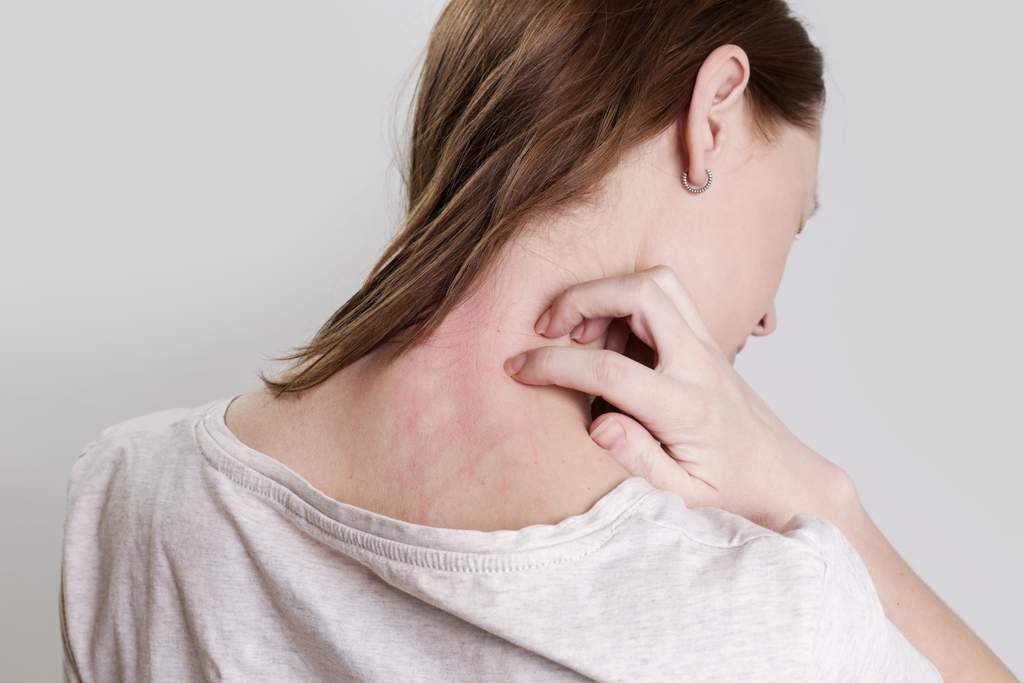 Itchy Rosacea