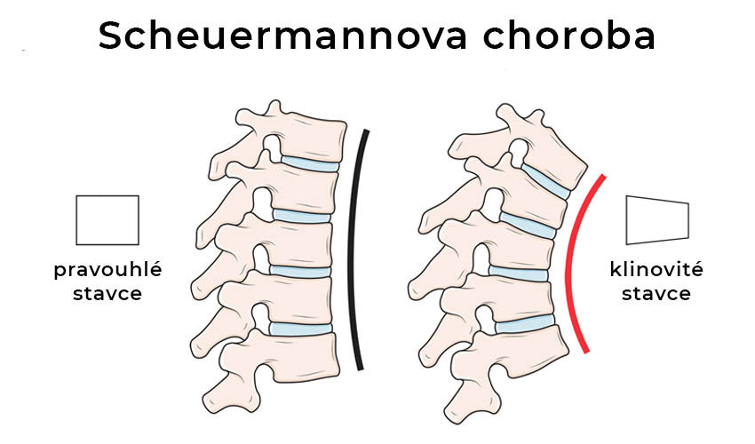 Scheuermannova choroba infografika