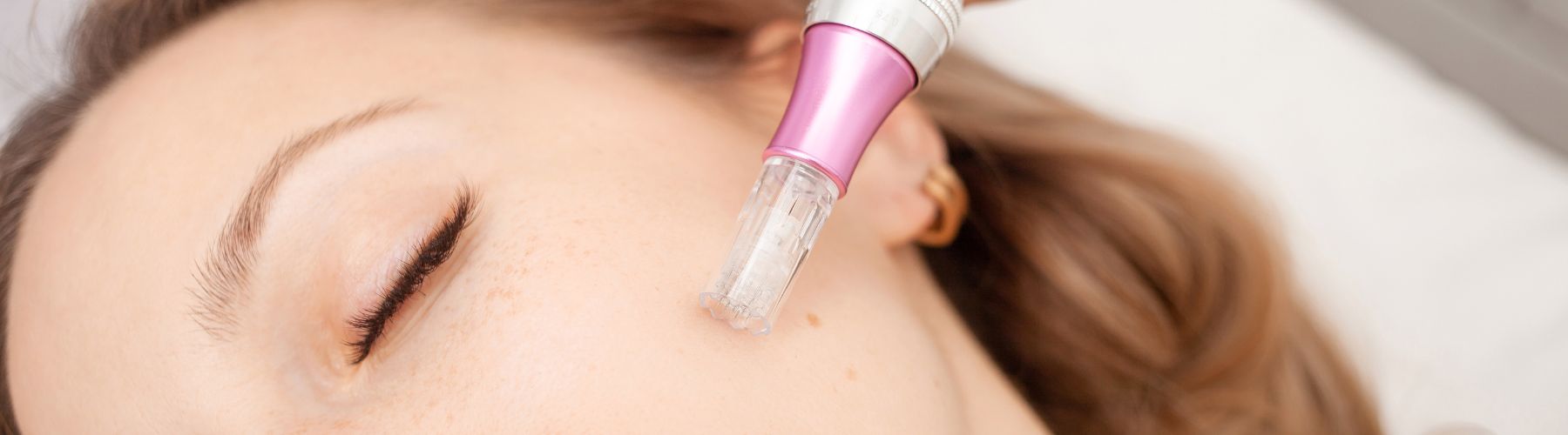 A woman benefiting from microneedling procedure.