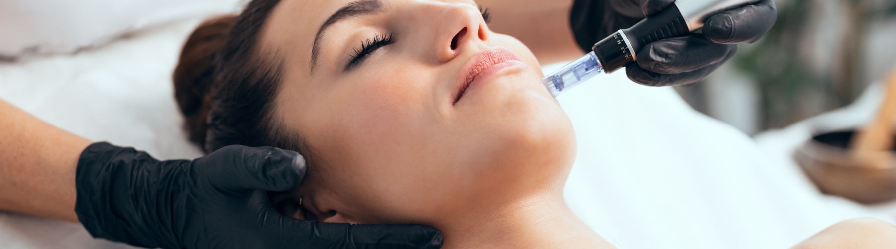 A woman receiving the benefits of microneedling.