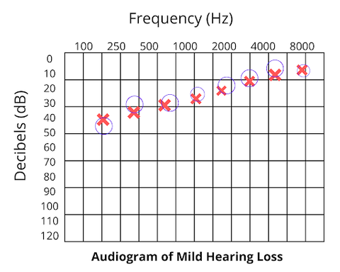 Mild Hearing Loss Level on a Hearing Loss Scale