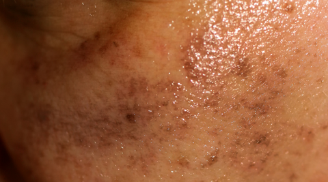 permanent-treatment-for-eczema-skin-disease	