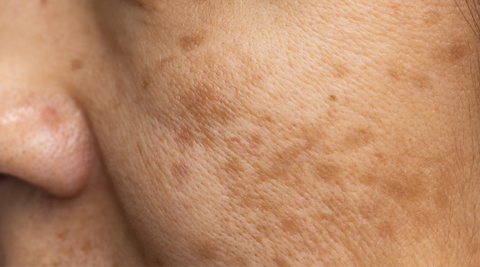 permanent-treatment-for-eczema-skin-disease	