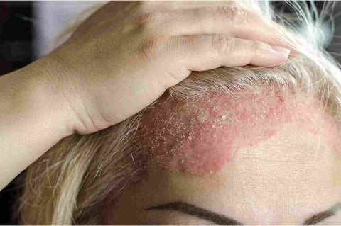 natural-scalp-psoriasis-treatment-cream