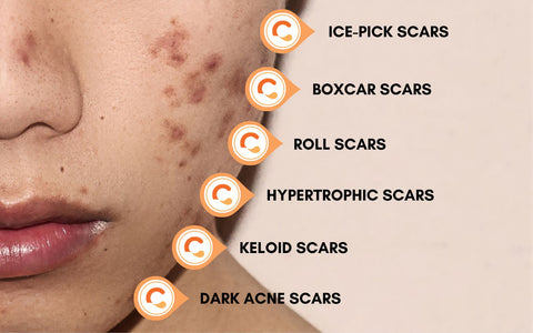 Types of scars