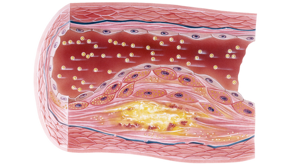 a cutaway of a blood vessel with atherosclerosis