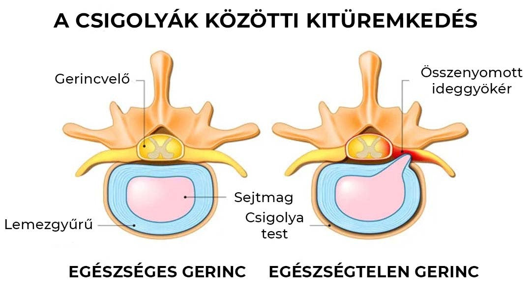 Gerinc velő csigolyák közötti betegség