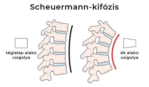 Scheuermann-kór infográf a gerinc hajlatáról