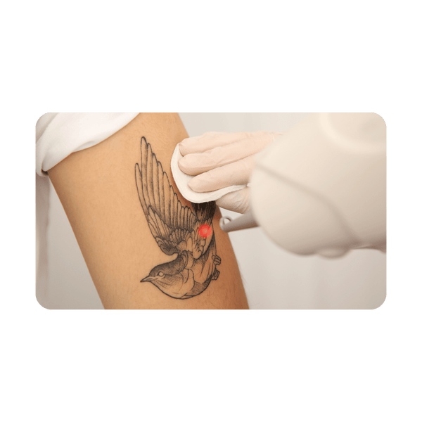 Tattoo Removal Business Consulting