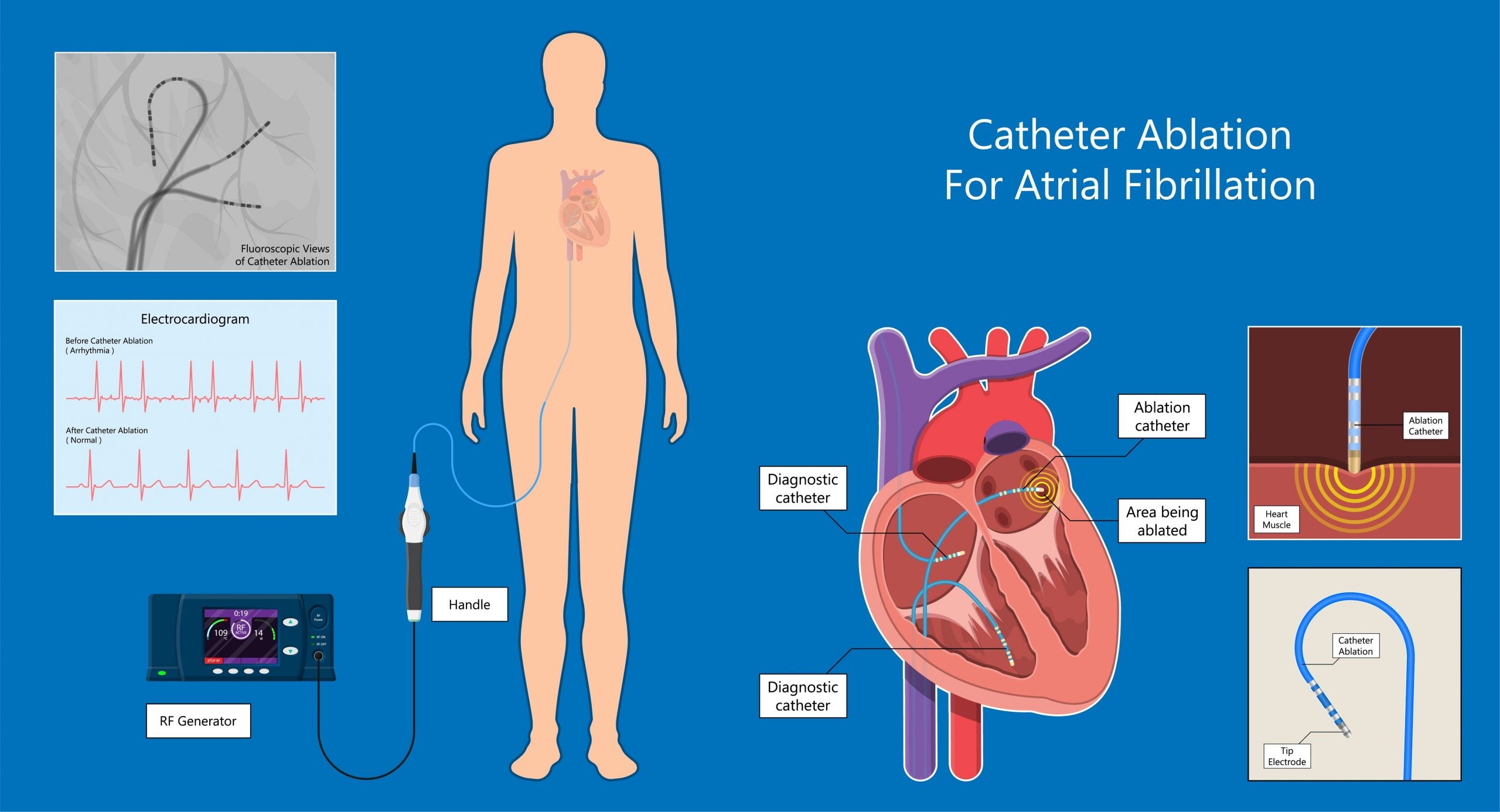 ”atrial