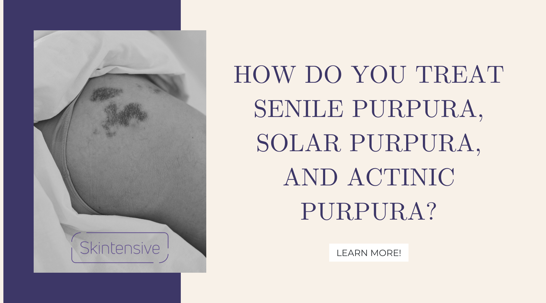 how-do-you-treat-senile-purpura-solar-purpura-and-actinic-purpura