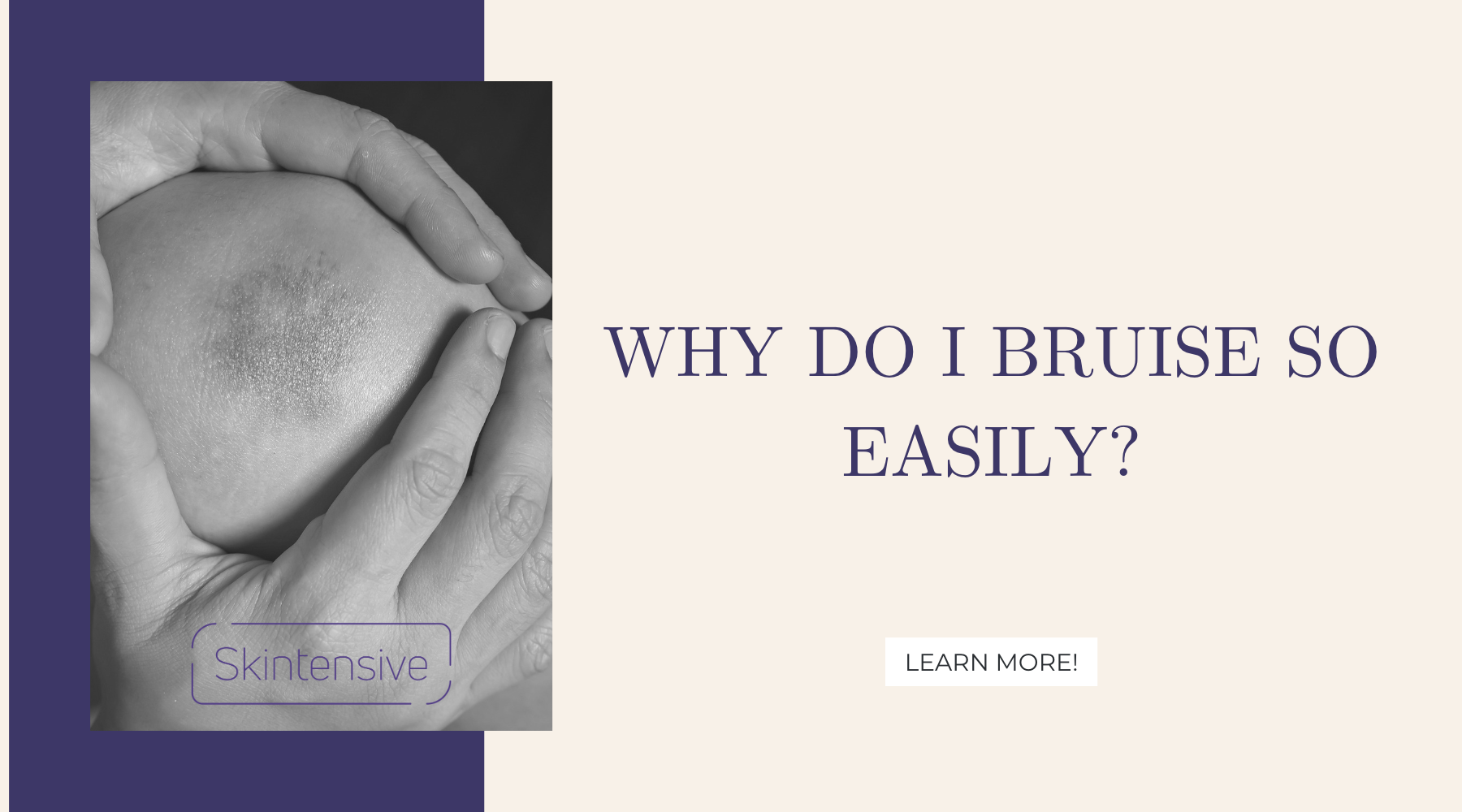 Skintensive Why Do I Bruise So Easily Causes Bruising ?v=1673291301