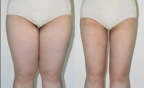 ultrasonic cavitation before and after photos leg