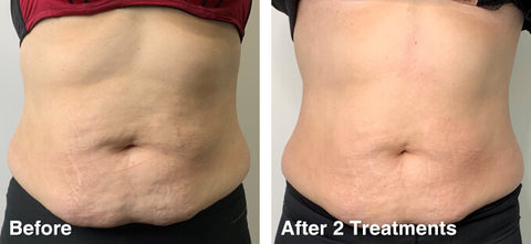 ultrasonic cavitation before and after photos belly