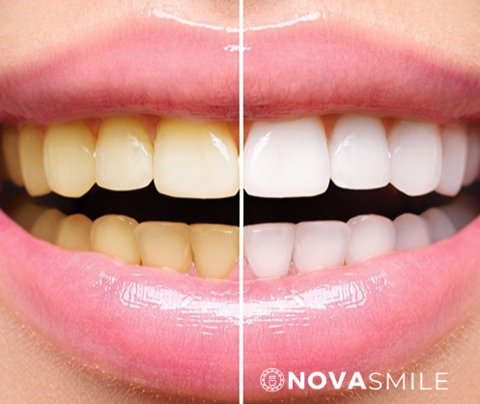 Beautiful South African model showing her smile makeover before and after using NovaSmile Premium Teeth Whitening kit