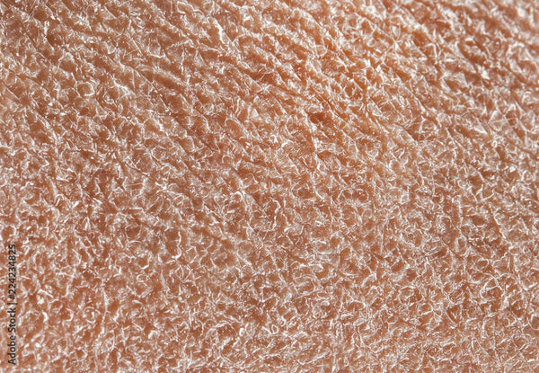 Dry Skin Up Close