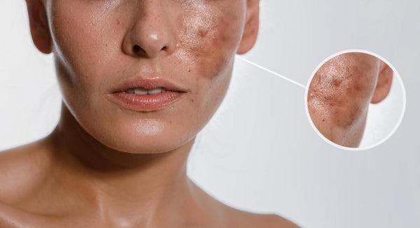 Hyperpigmentation