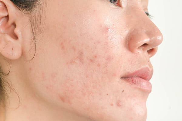 Skincare for Acne-Prone Skin