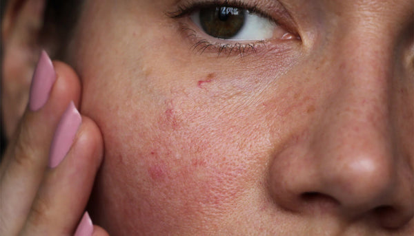 Woman with Sensitive Skin