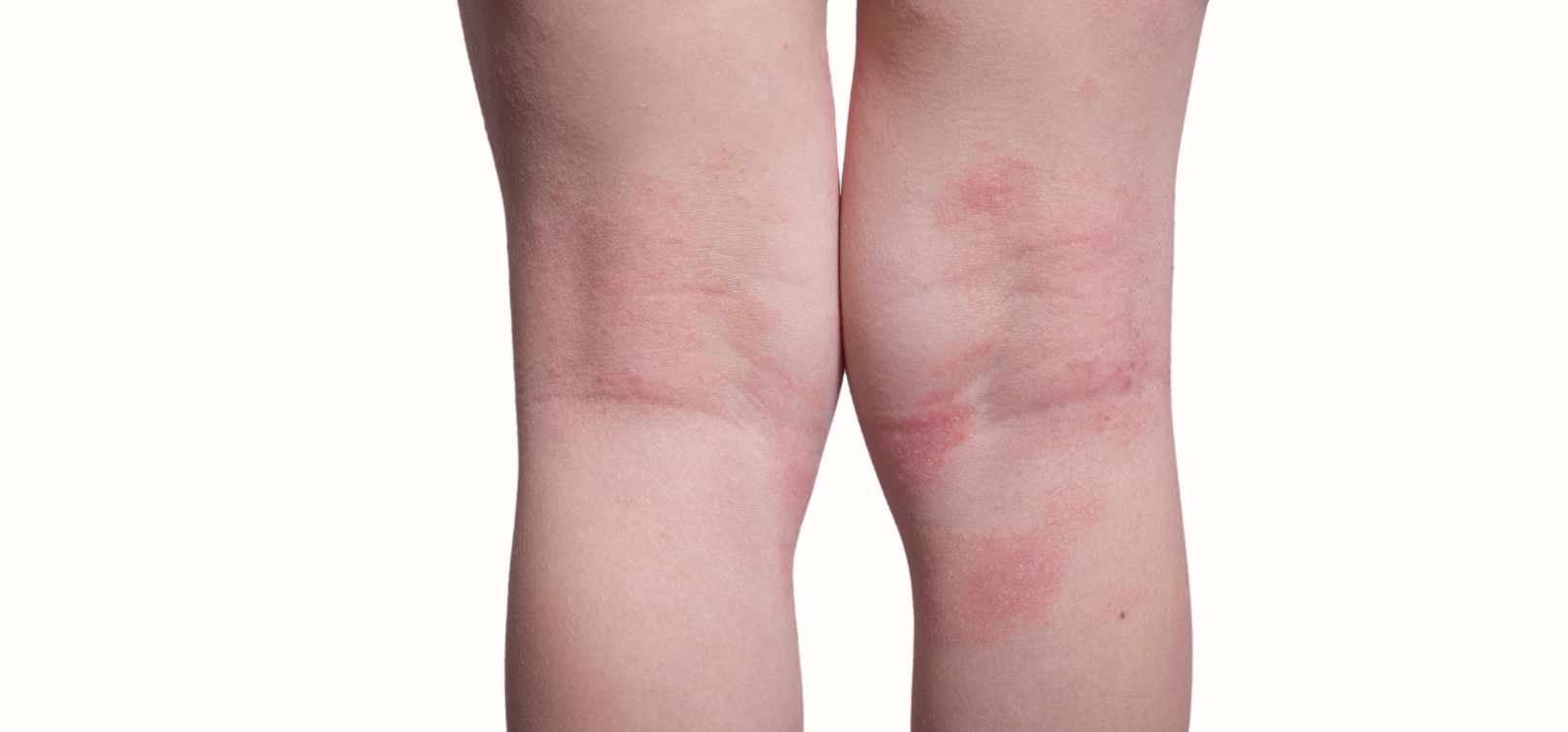 eczema example image