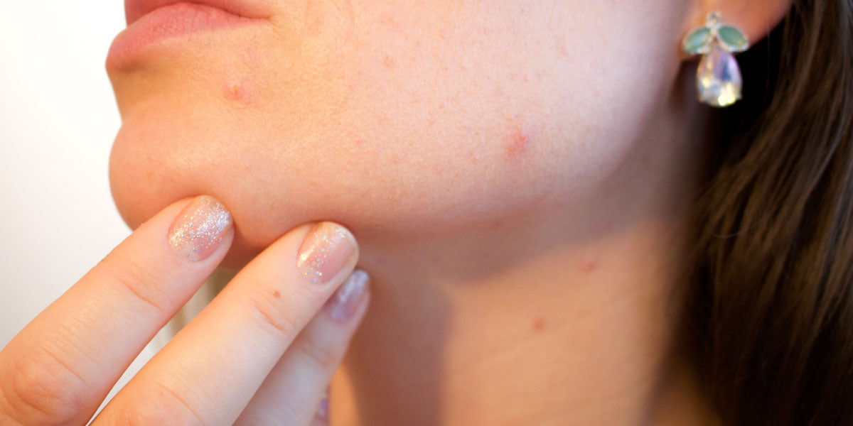 How acne forms on our skin - Nutrova