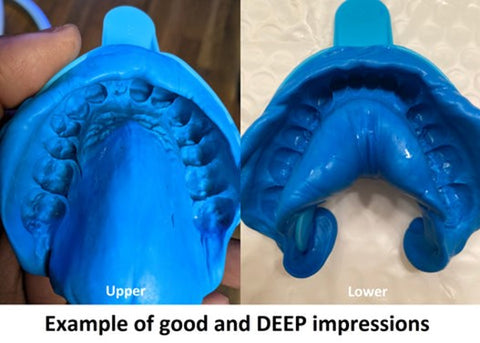 Dental Impression Kit System: Order Yours for Custom Fit – Rosenthal Dental  Laboratory