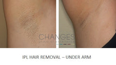 under arm hair removal