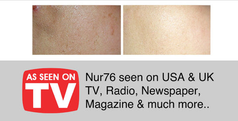 NUR76-SKIN-LIGHTENING