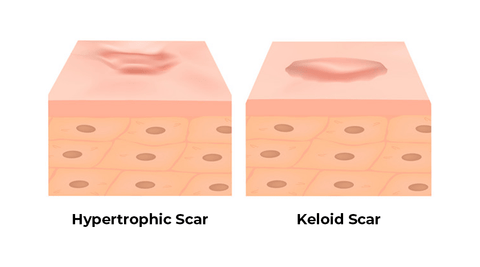 Difference Between a Keloid and Hypertrophic Scar