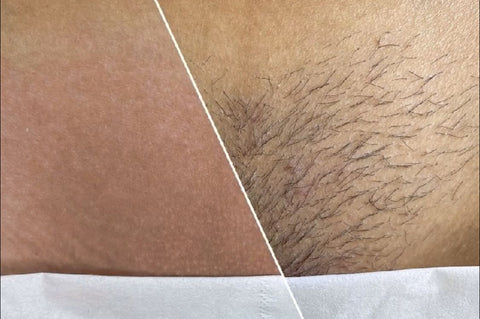 Brazilian Waxing