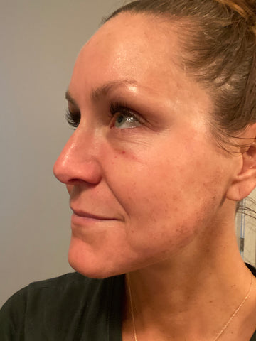 Day 1 Post Forever Young BBL Preveda Health & Esthetics
