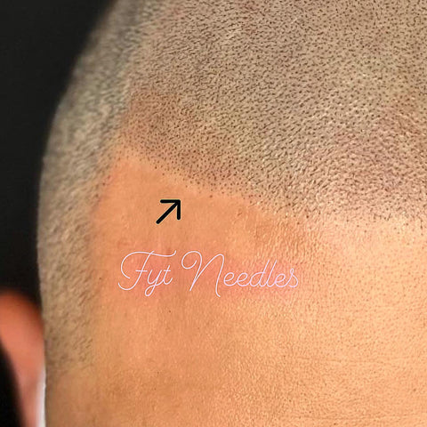 scalp micropigmentation