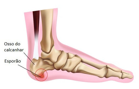 tratamento esporão fascite plantar