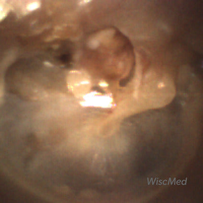 Right Ear Cholesteatoma