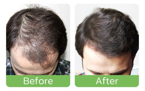 HaarGrowthPlus - Kräftigendes Haarwachstum Haarpflege Serum - 120ml Spray Lotion Haarpflege