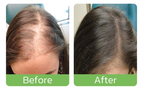 HaarGrowthPlus - Serum forcues për rritjen e flokëve për kujdesin e flokëve - 120 ml Spray Lotion Kujdesi për flokët