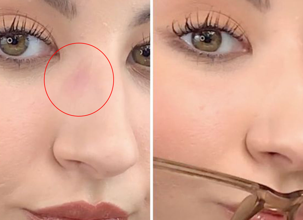 How Do I Get Rid Of Glasses Marks On My Nose | KoalaEye – Koalaeye.com