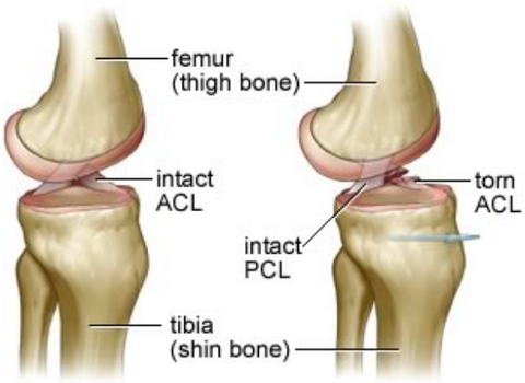 ACL Injury