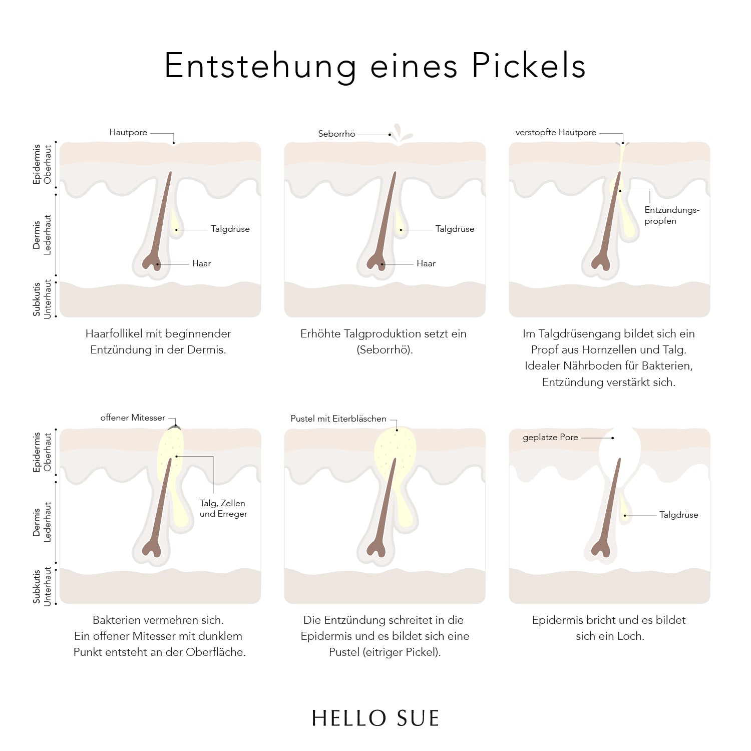 Entstehung eines Pickels